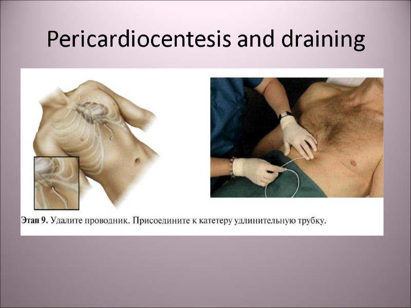 Pericardiocentesis and draining